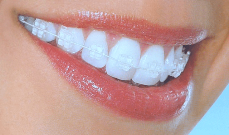 https://www.eliteod.com/wp-content/uploads/2022/10/Invisible-Braces-Available.png